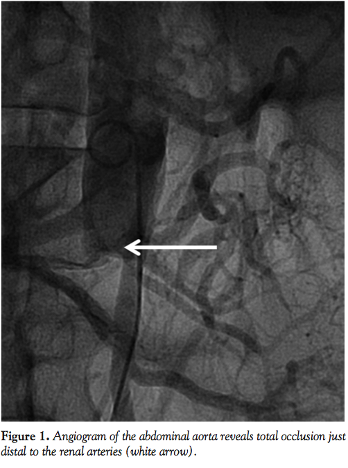 Use of a Novel Adjunctive KissingBalloon Technique with the Trellis Device to Successfully